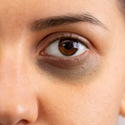 Dark Circles Under Eyes